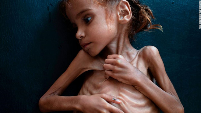 Bức ảnh chụp Amal Hussain, 7 tuổi, bị suy dinh dưỡng nặng.